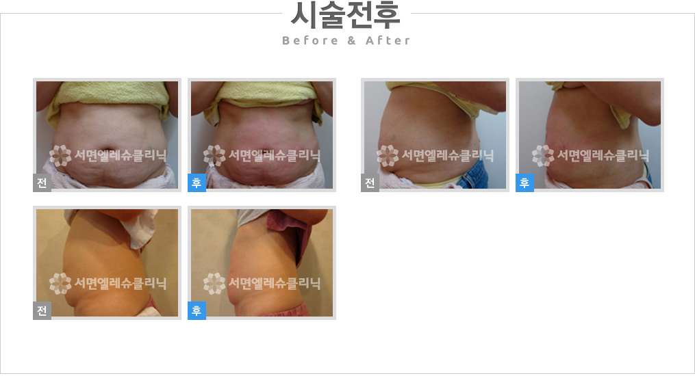 비만