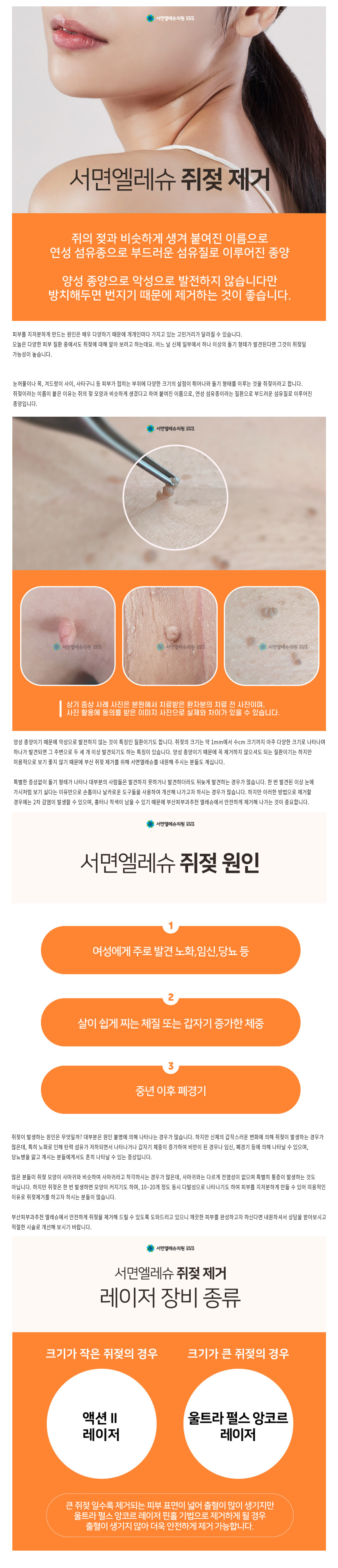쥐젖