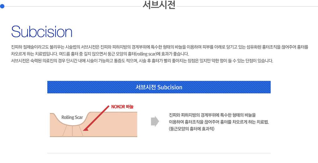 서브시전